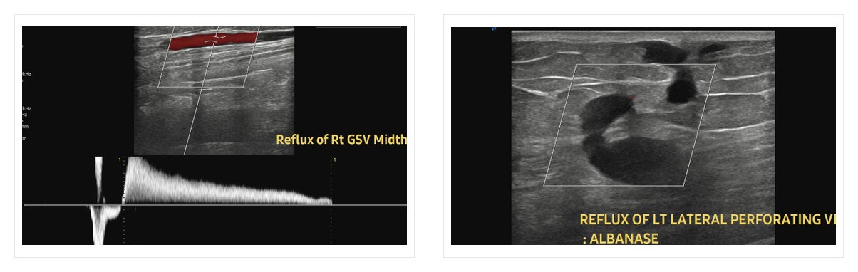 venous_reflux_ultrasound.jpg